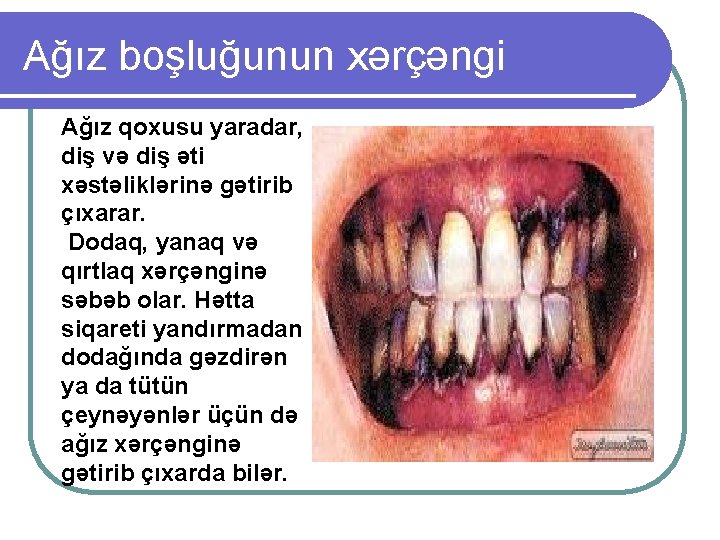 Ağız boşluğunun xərçəngi Ağız qoxusu yaradar, diş və diş əti xəstəliklərinə gətirib çıxarar. Dodaq,