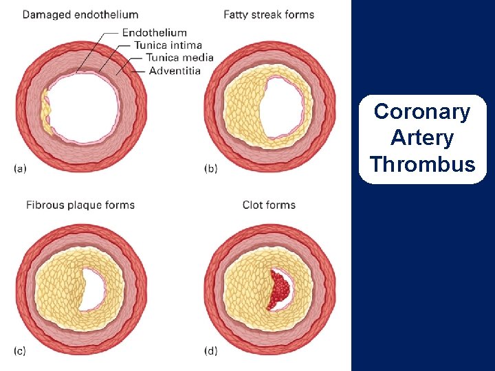 Coronary Artery Thrombus 