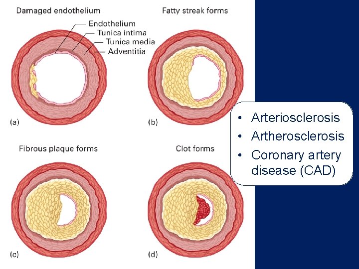  • Arteriosclerosis • Artherosclerosis • Coronary artery disease (CAD) 
