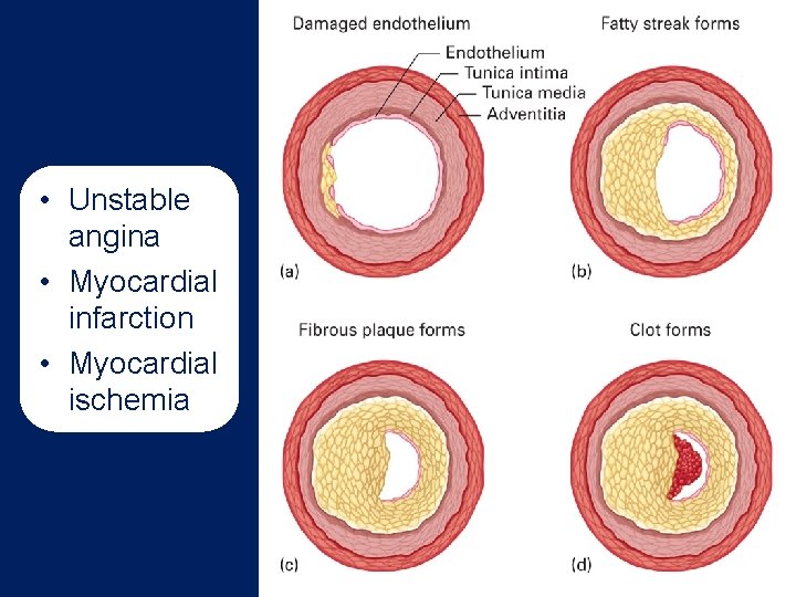  • Unstable angina • Myocardial infarction • Myocardial ischemia 