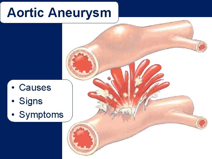 Aortic Aneurysm • Causes • Signs • Symptoms 