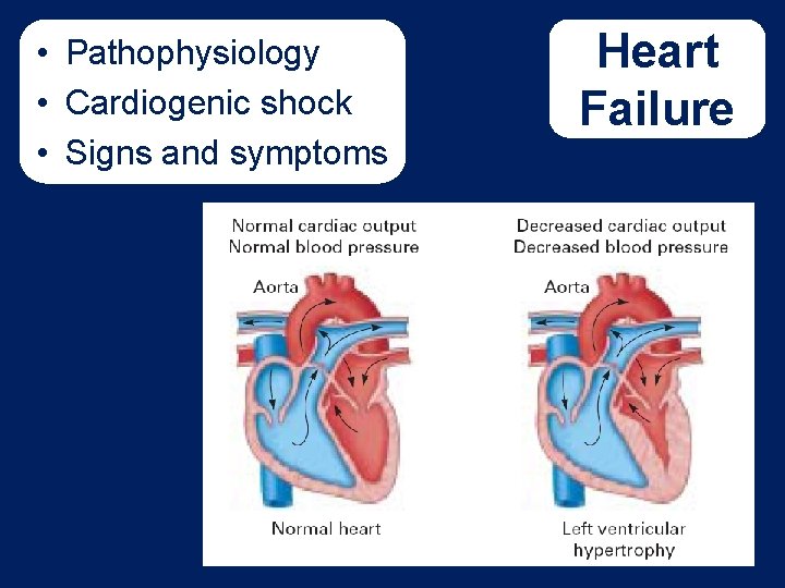  • Pathophysiology • Cardiogenic shock • Signs and symptoms Heart Failure Don’t have