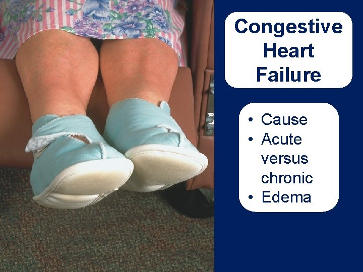 Congestive Heart Failure • Cause • Acute versus chronic • Edema 