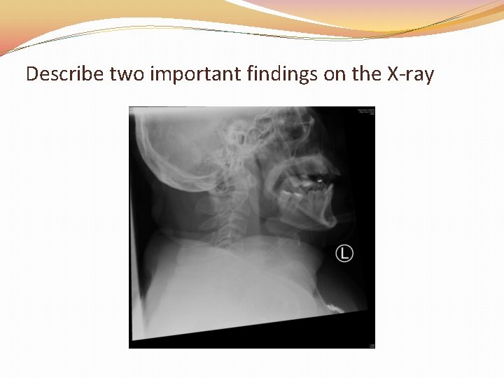 Describe two important findings on the X-ray 
