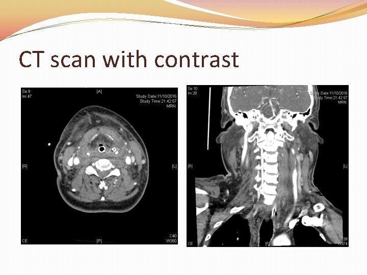CT scan with contrast 