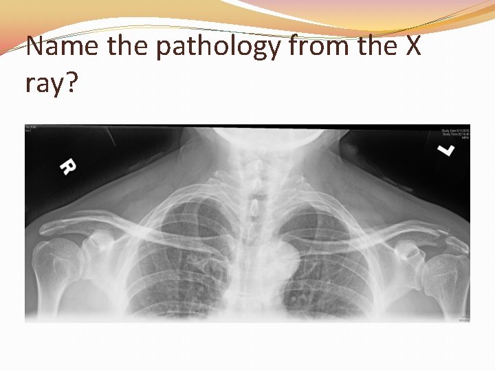 Name the pathology from the X ray? 