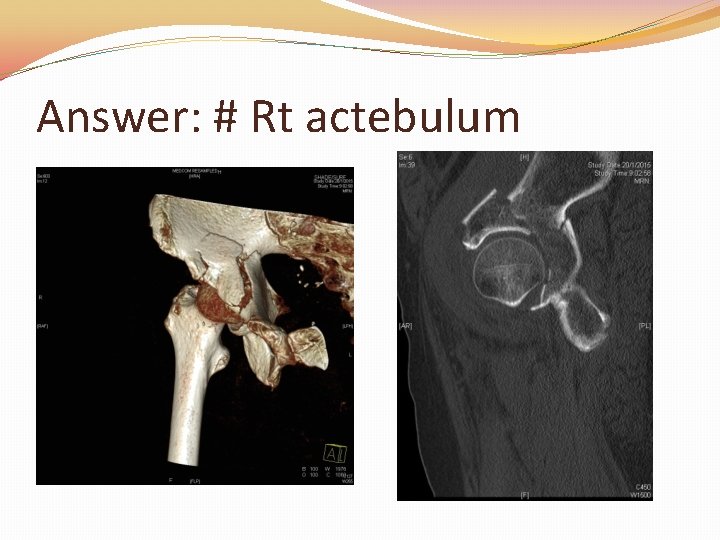 Answer: # Rt actebulum 