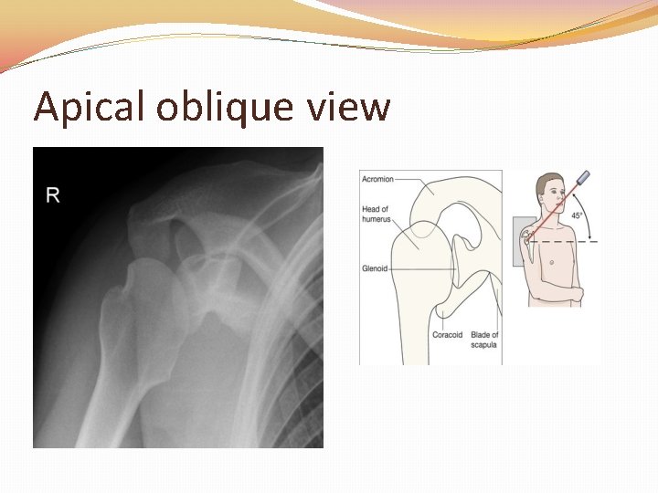 Apical oblique view 