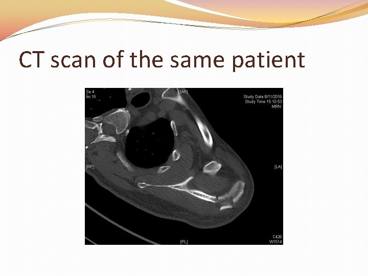 CT scan of the same patient 