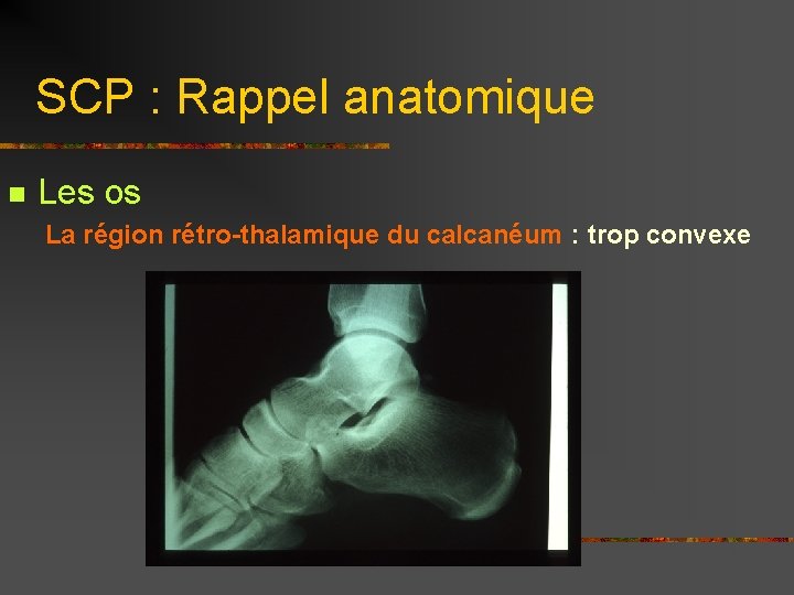 SCP : Rappel anatomique n Les os La région rétro-thalamique du calcanéum : trop