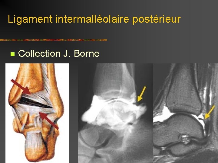 Ligament intermalléolaire postérieur n Collection J. Borne 
