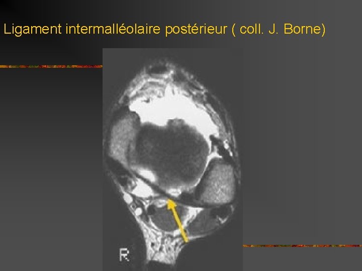 Ligament intermalléolaire postérieur ( coll. J. Borne) 