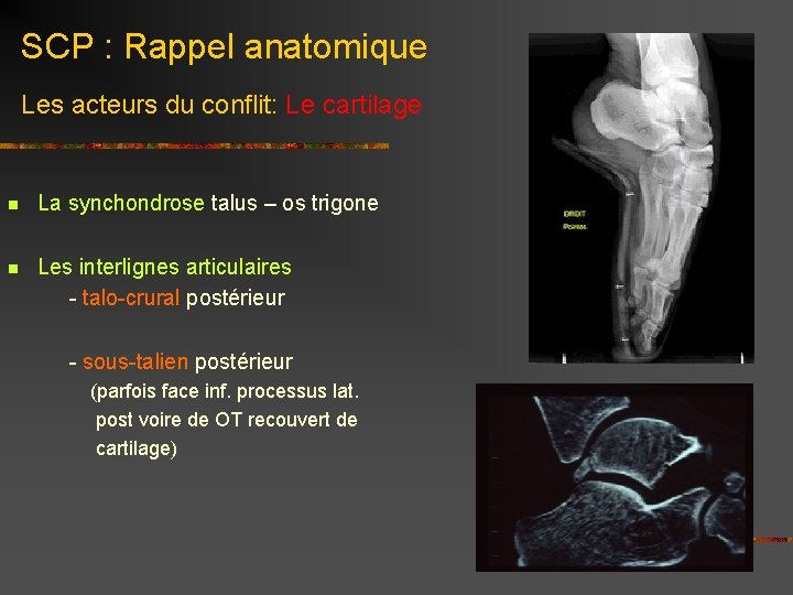 SCP : Rappel anatomique Les acteurs du conflit: Le cartilage n La synchondrose talus