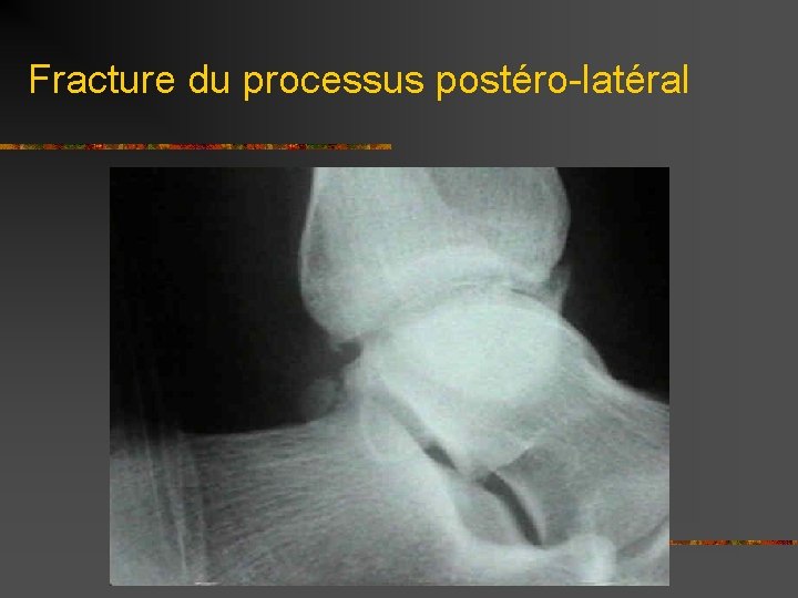 Fracture du processus postéro-latéral 