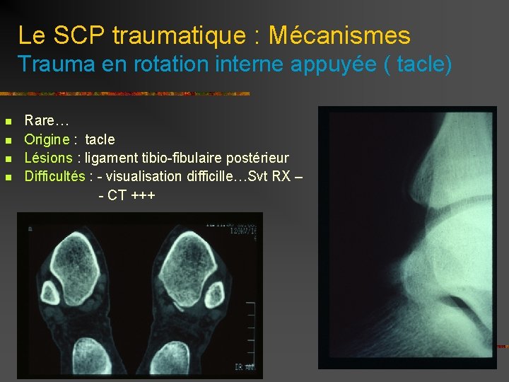 Le SCP traumatique : Mécanismes Trauma en rotation interne appuyée ( tacle) Rare… n