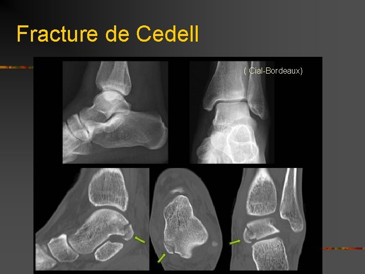 Fracture de Cedell ( Cial-Bordeaux) 