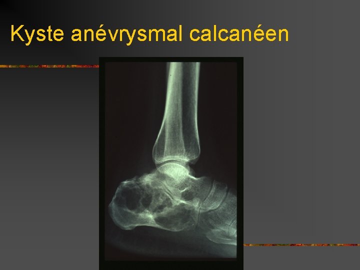 Kyste anévrysmal calcanéen 