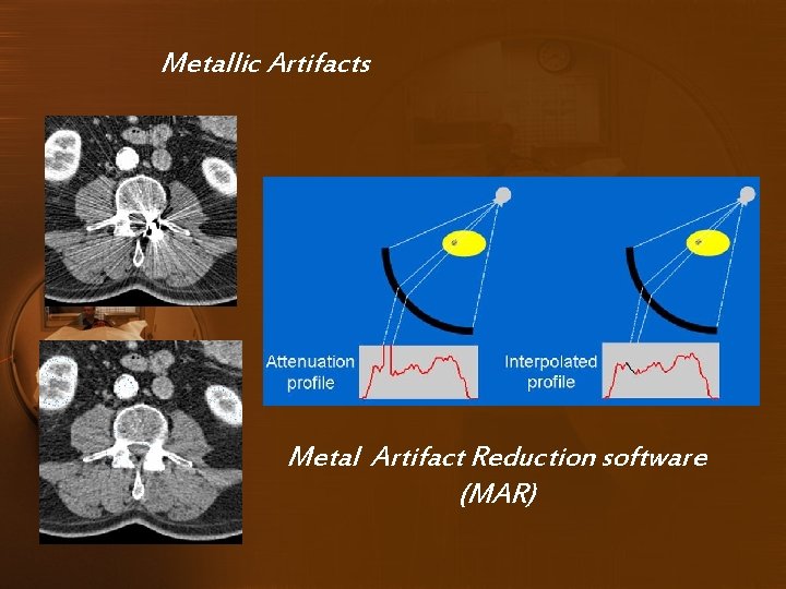 Metallic Artifacts Metal Artifact Reduction software (MAR) 