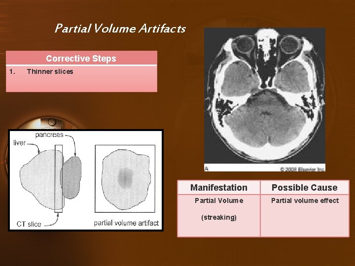 Partial Volume Artifacts Corrective Steps 1. Thinner slices Manifestation Possible Cause Partial Volume Partial