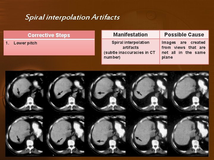 Spiral interpolation Artifacts Corrective Steps 1. Lower pitch Manifestation Possible Cause Spiral interpolation artifacts