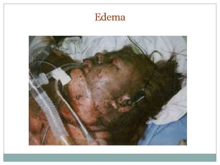 Edema 