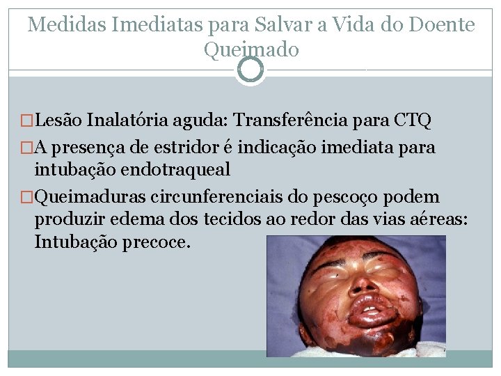 Medidas Imediatas para Salvar a Vida do Doente Queimado �Lesão Inalatória aguda: Transferência para