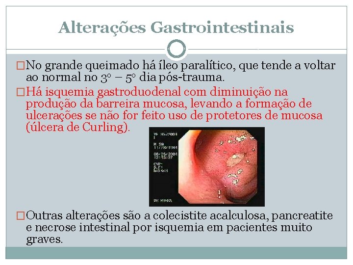 Alterações Gastrointestinais �No grande queimado há íleo paralítico, que tende a voltar ao normal