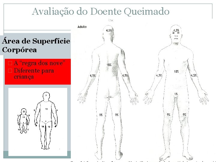 Avaliação do Doente Queimado Área de Superfície Corpórea � A “regra dos nove” �