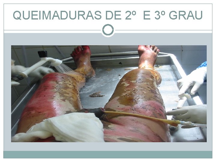 QUEIMADURAS DE 2º E 3º GRAU 