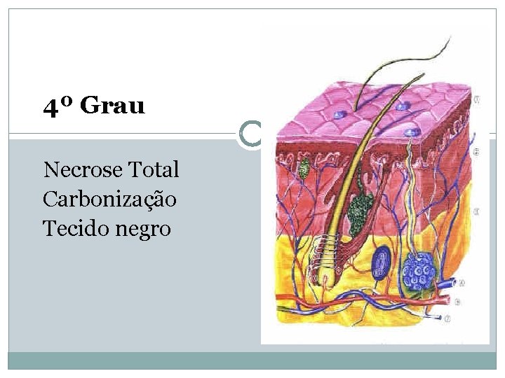 4º Grau Necrose Total Carbonização Tecido negro 