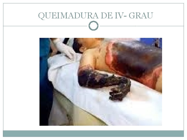 QUEIMADURA DE IV- GRAU 