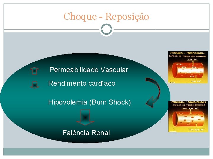 Choque - Reposição Permeabilidade Vascular Rendimento cardíaco Hipovolemia (Burn Shock) Falência Renal 