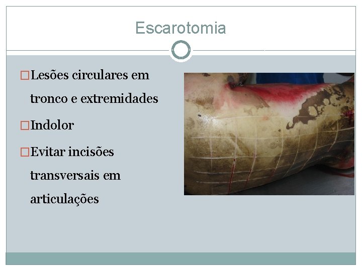 Escarotomia �Lesões circulares em tronco e extremidades �Indolor �Evitar incisões transversais em articulações 