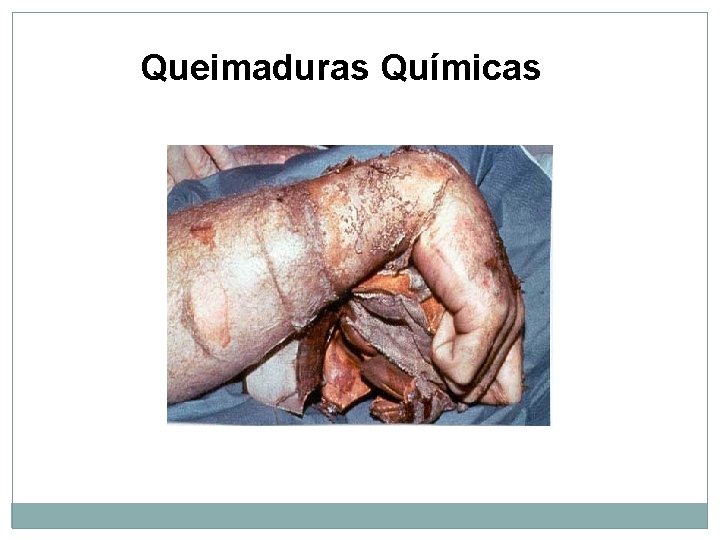 Queimaduras Químicas 