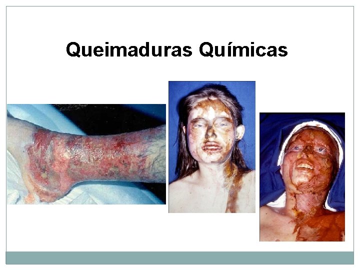 Queimaduras Químicas 