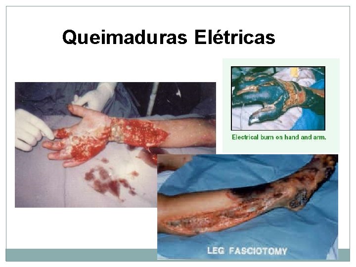 Queimaduras Elétricas 