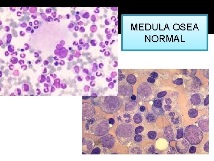 MEDULA OSEA NORMAL 