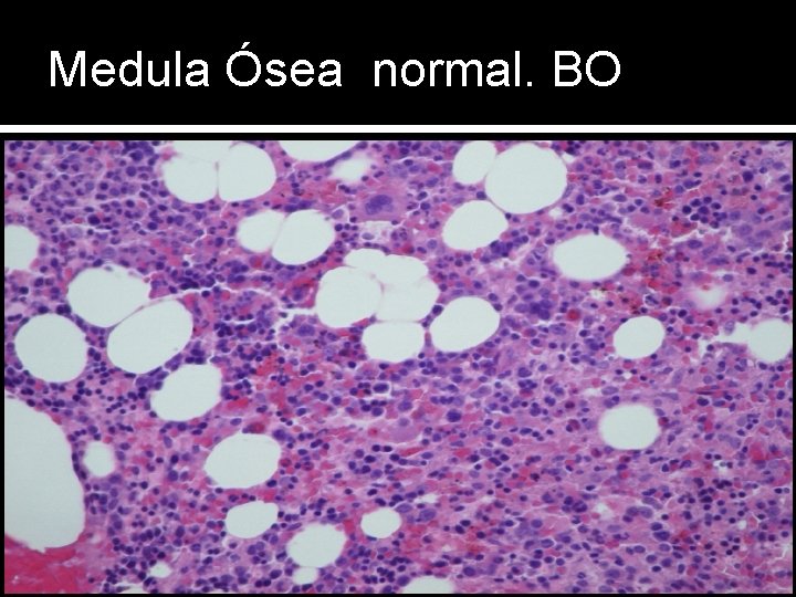 Medula Ósea normal. BO 