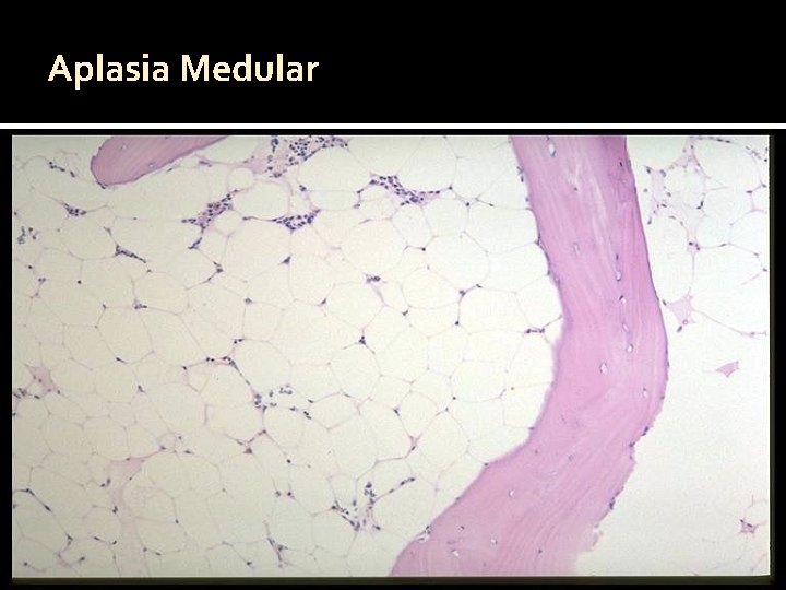 Aplasia Medular 