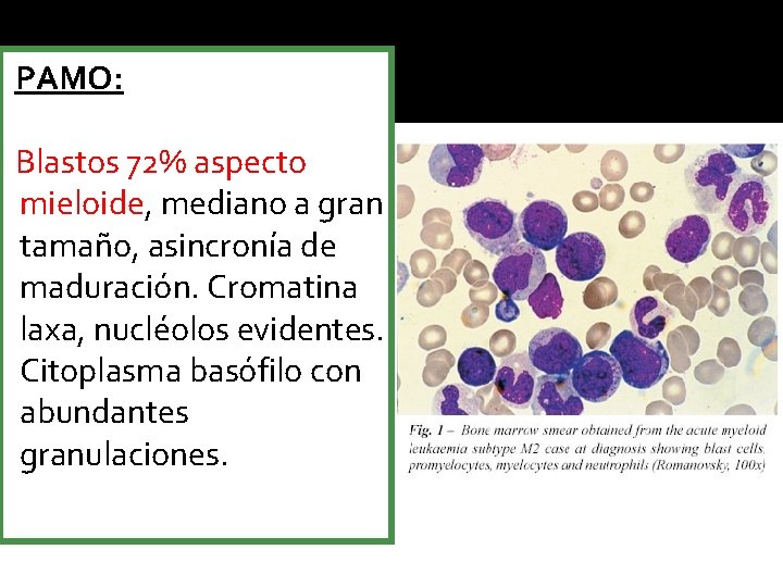 PAMO: Blastos 72% aspecto mieloide, mediano a gran tamaño, asincronía de maduración. Cromatina laxa,