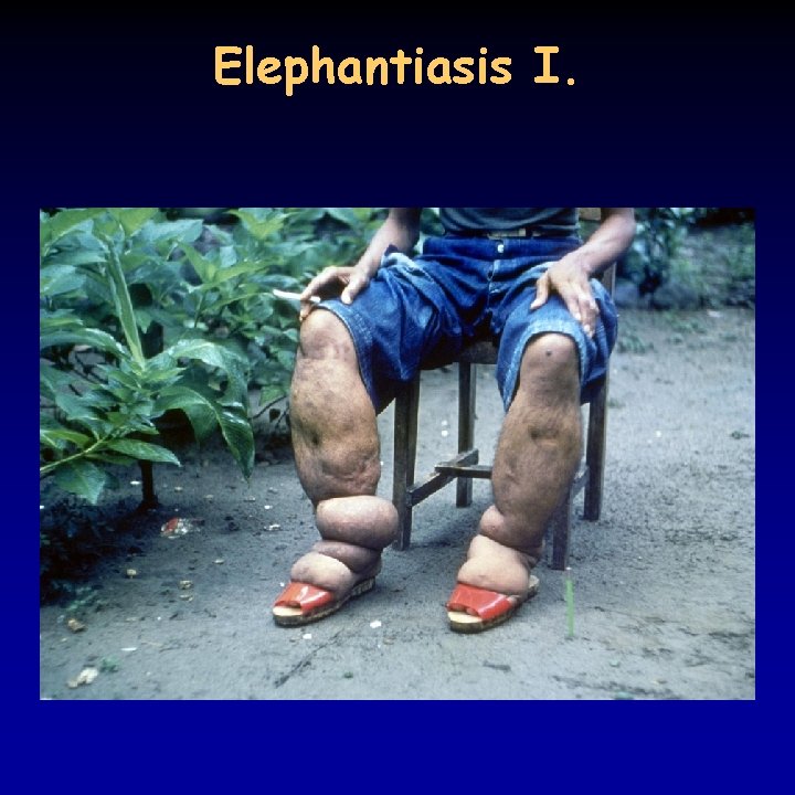 Elephantiasis I. 