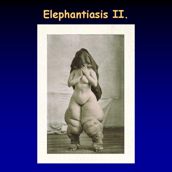 Elephantiasis II. 