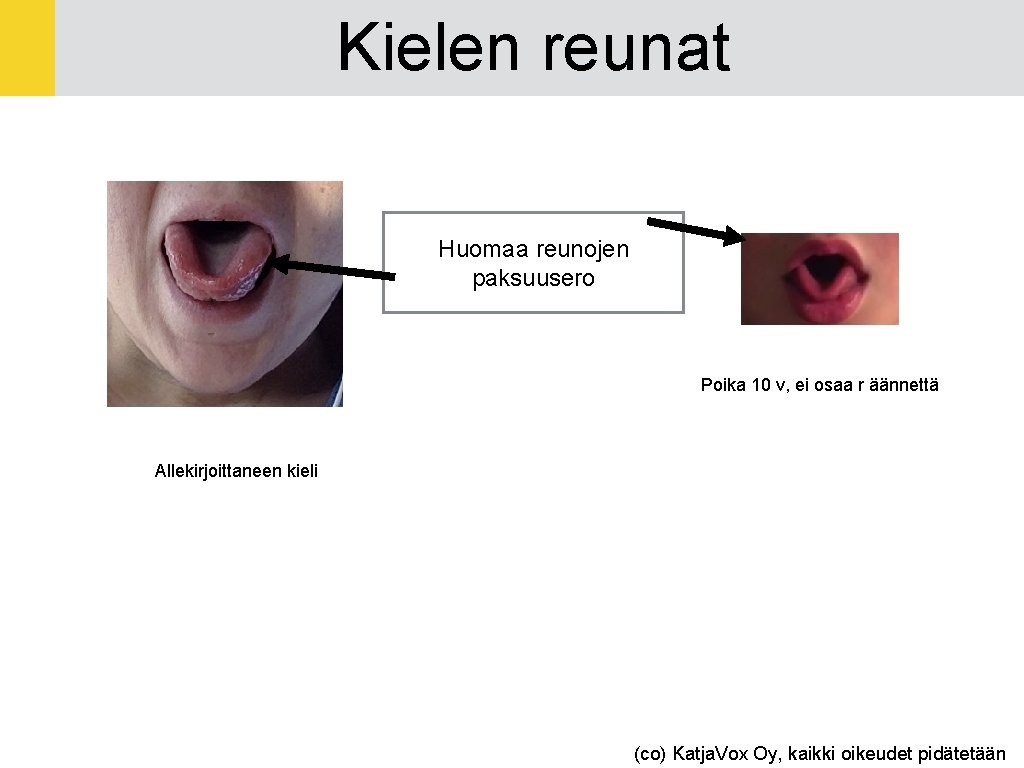 Kielen reunat Huomaa reunojen paksuusero Poika 10 v, ei osaa r äännettä Allekirjoittaneen kieli