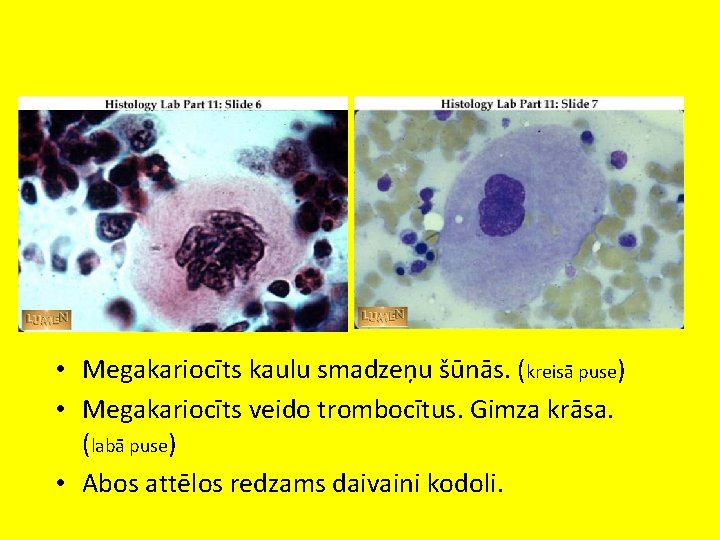  • Megakariocīts kaulu smadzeņu šūnās. (kreisā puse) • Megakariocīts veido trombocītus. Gimza krāsa.