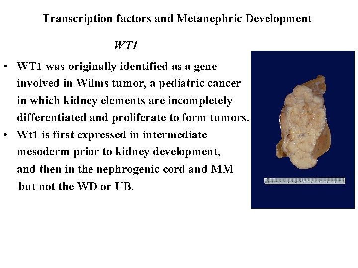 Transcription factors and Metanephric Development WT 1 • WT 1 was originally identified as Transcription factors and Metanephric Development WT 1 • WT 1 was originally identified as