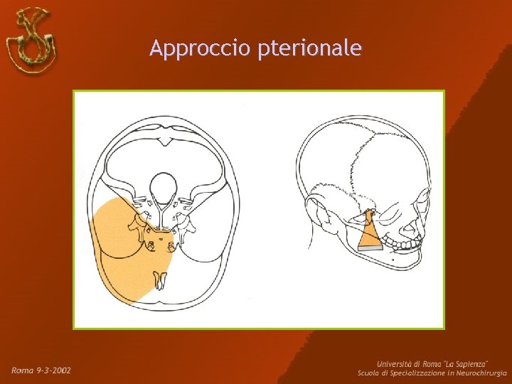 Approccio pterionale Approccio pterionale