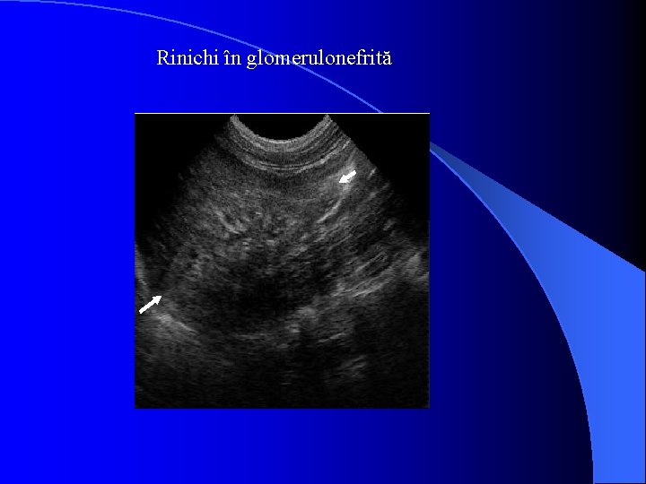 Rinichi în glomerulonefrită 