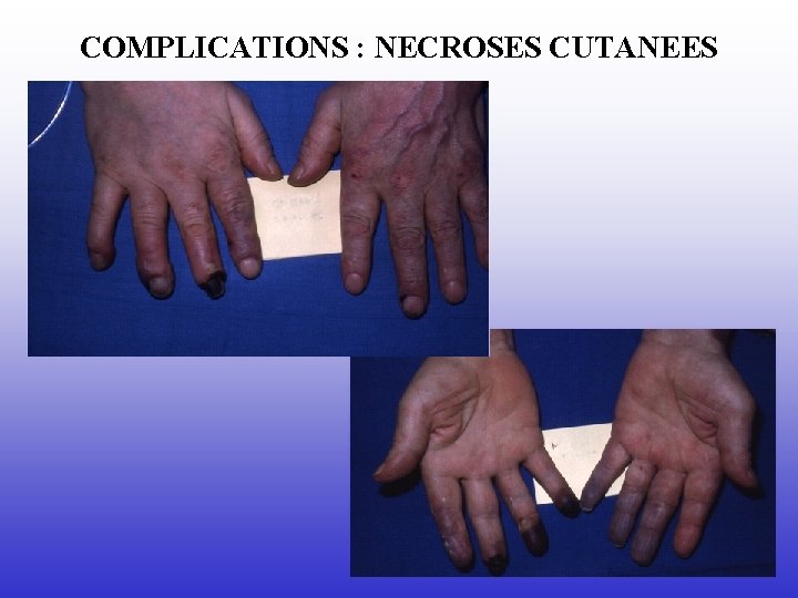 COMPLICATIONS : NECROSES CUTANEES 