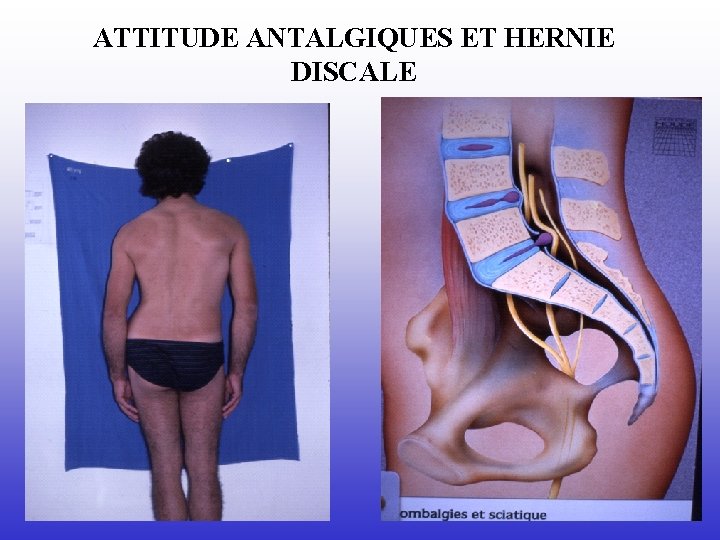 ATTITUDE ANTALGIQUES ET HERNIE DISCALE 