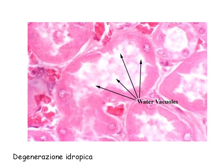 Degenerazione idropica 